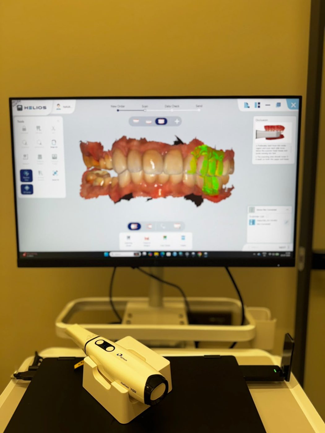 Helios 700 wireless intraoral scanner capturing a digital impression